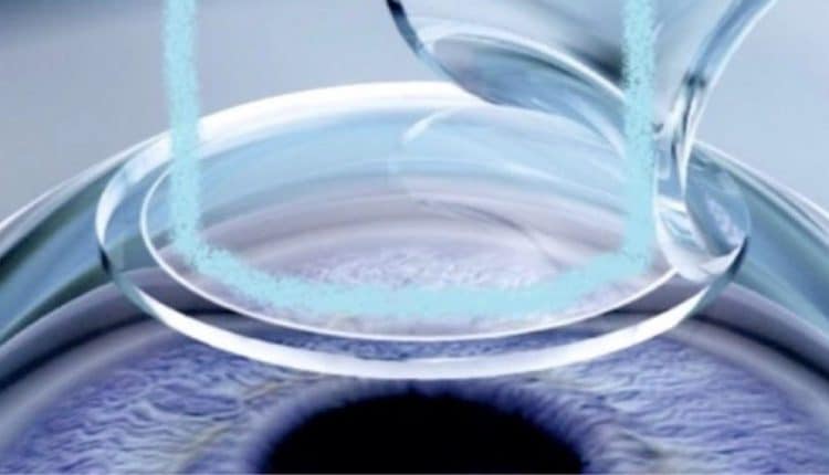 Chirurgia refrattiva e laser a eccimeri