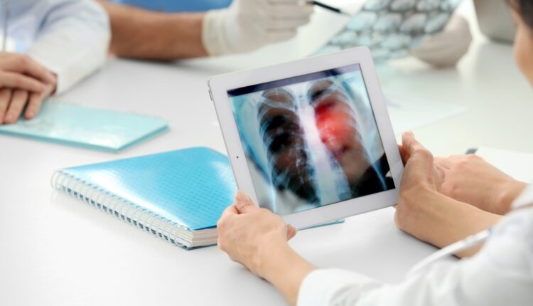 Lombardia, avvia programmi screening per tumore a prostata e polmoni