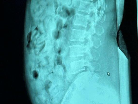 Bergamo, arrestata a Orio al Serio passeggera con 120 ovuli di eroina ingeriti